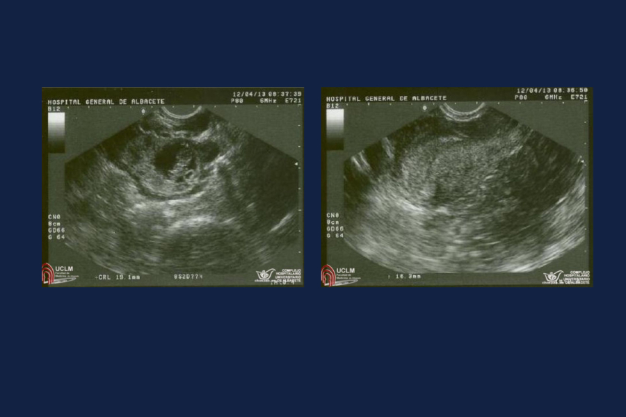 Benemérita Universidad Autónoma de Chiapas destaca investigación estudiantil en reporte de caso clínico sobre embarazo ectópico